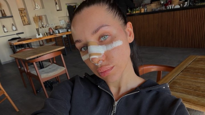 Bianka Rumanová po plastike nosa